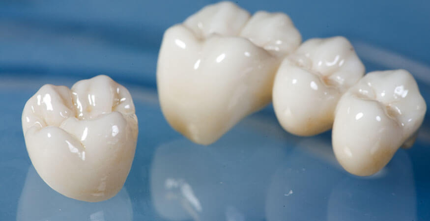 Zirconium Crown in 10 Questions