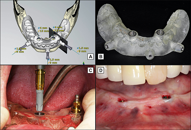 Seamless Implant